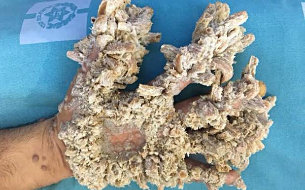 Otro caso de 'hombre árbol'