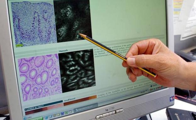 La Consejería paraliza el plan de prevención del cáncer de colon en cuatro áreas de salud