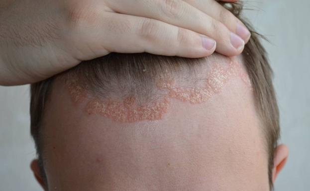 La UMU detecta dos proteínas que reducen la inflamación causada por la psoriasis