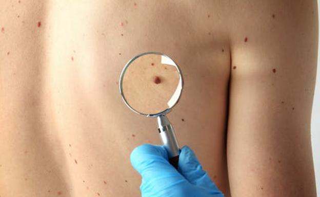 ¿Cuándo debemos preocuparnos por la aparición de lunares?