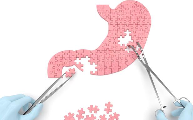 Más cirugía de la obesidad. ¿Por qué ha aumentado un 30% a causa de la pandemia?