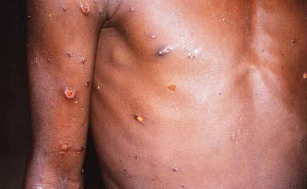 El virus de la viruela del simio es un viejo conocido