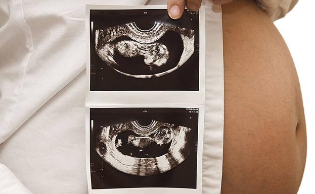 Por qué aparecen las estrías y cuál es la verdadera relación que tienen con el embarazo