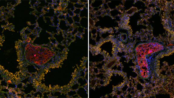 Identifican los nichos metastásicos para atacar la expansión del cáncer