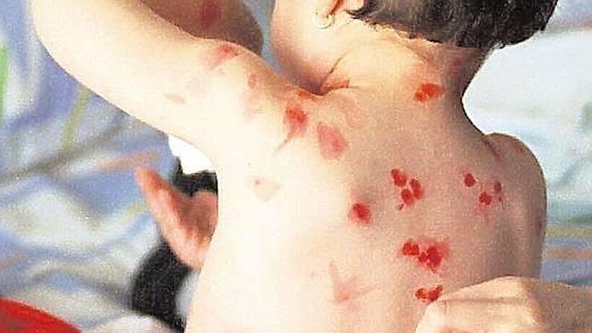 Los médicos no inyectan la vacuna contra la varicela comprada fuera de España