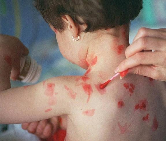 La varicela ya ha subido un 14% desde que se bloqueó la venta de la vacuna