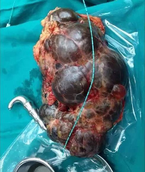 Extraen en la India un riñón del tamaño de un bebé