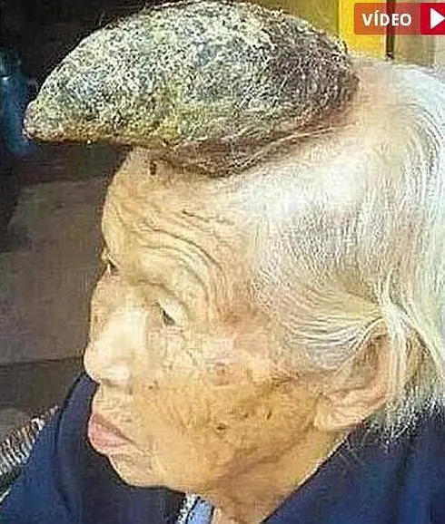 A una anciana le crece un inexplicable cuerno en la cabeza