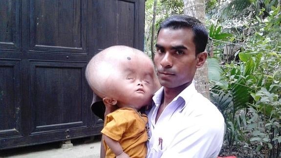 Los padres de un niño con la cabeza de 10 kilos piden ayuda para operarlo