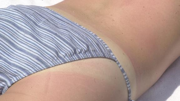 Remedios contra las quemaduras solares