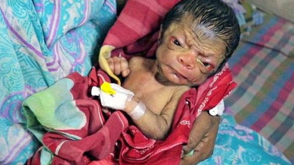 Nace un bebé con aspecto de anciano en Bangladesh