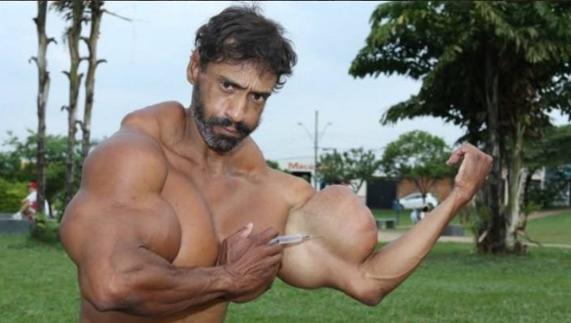 Un hombre se inyecta aceite en los bíceps para conseguir el récord mundial de 78 centímetros